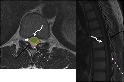 Imaging of metastatic epidural spinal cord compression